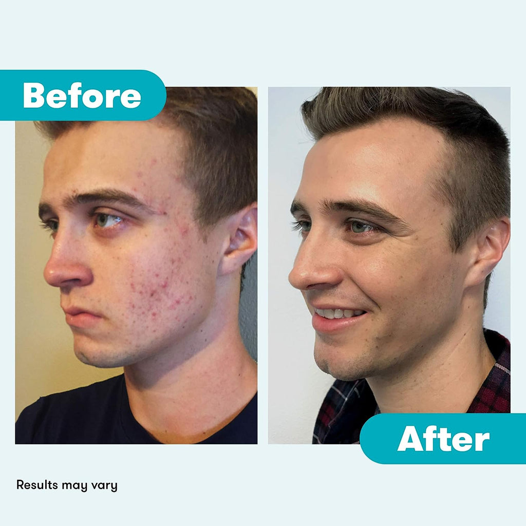 Proactiv 3 Step Acne Treatment - Benzoyl Peroxide Face Wash, Repairing Acne Spot Treatment for Face and Body, Exfoliating Toner - 90 Day Complete Acne Skin Care Kit